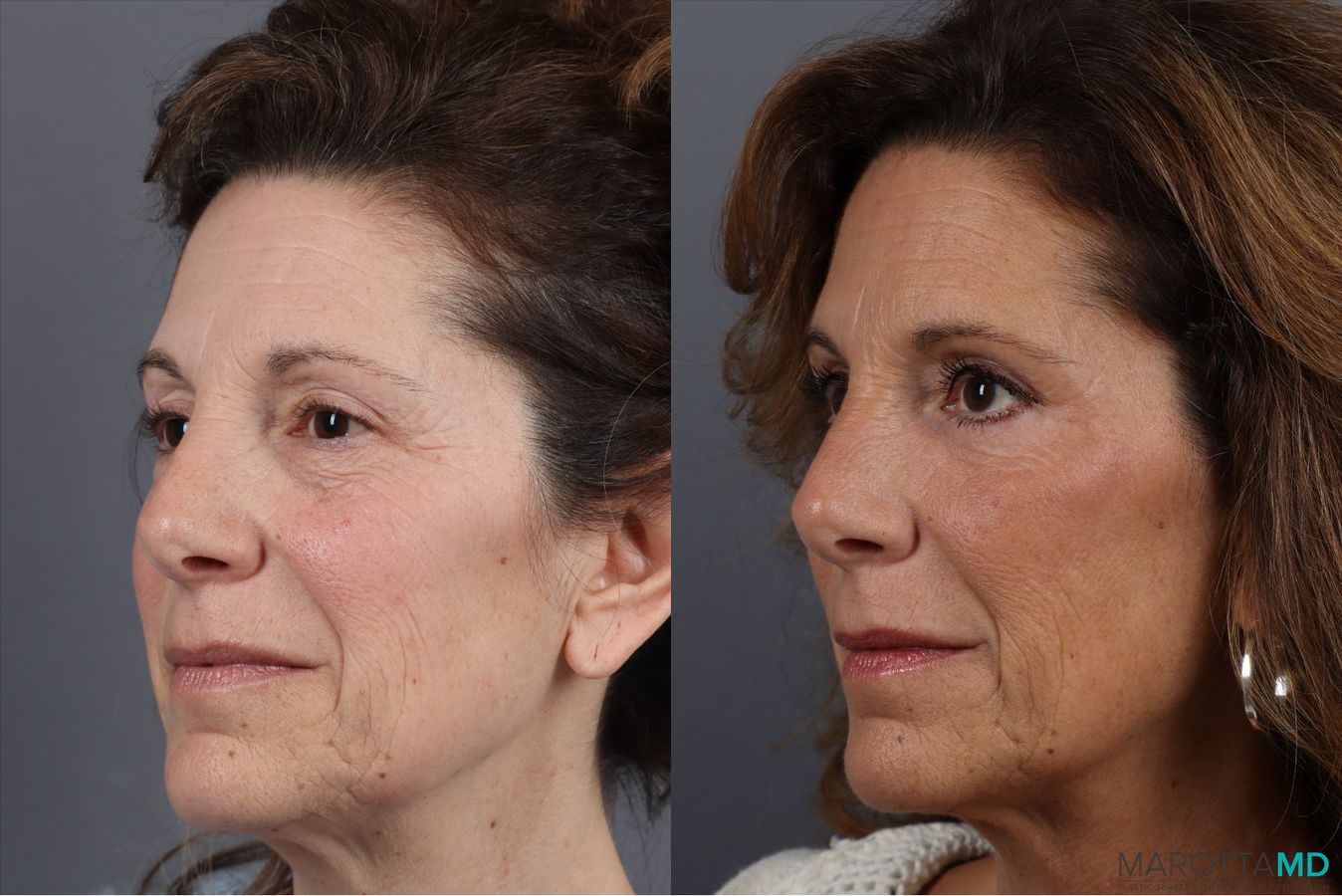 Before and after Blepharoplasty Lower case 41924 - Angle 3