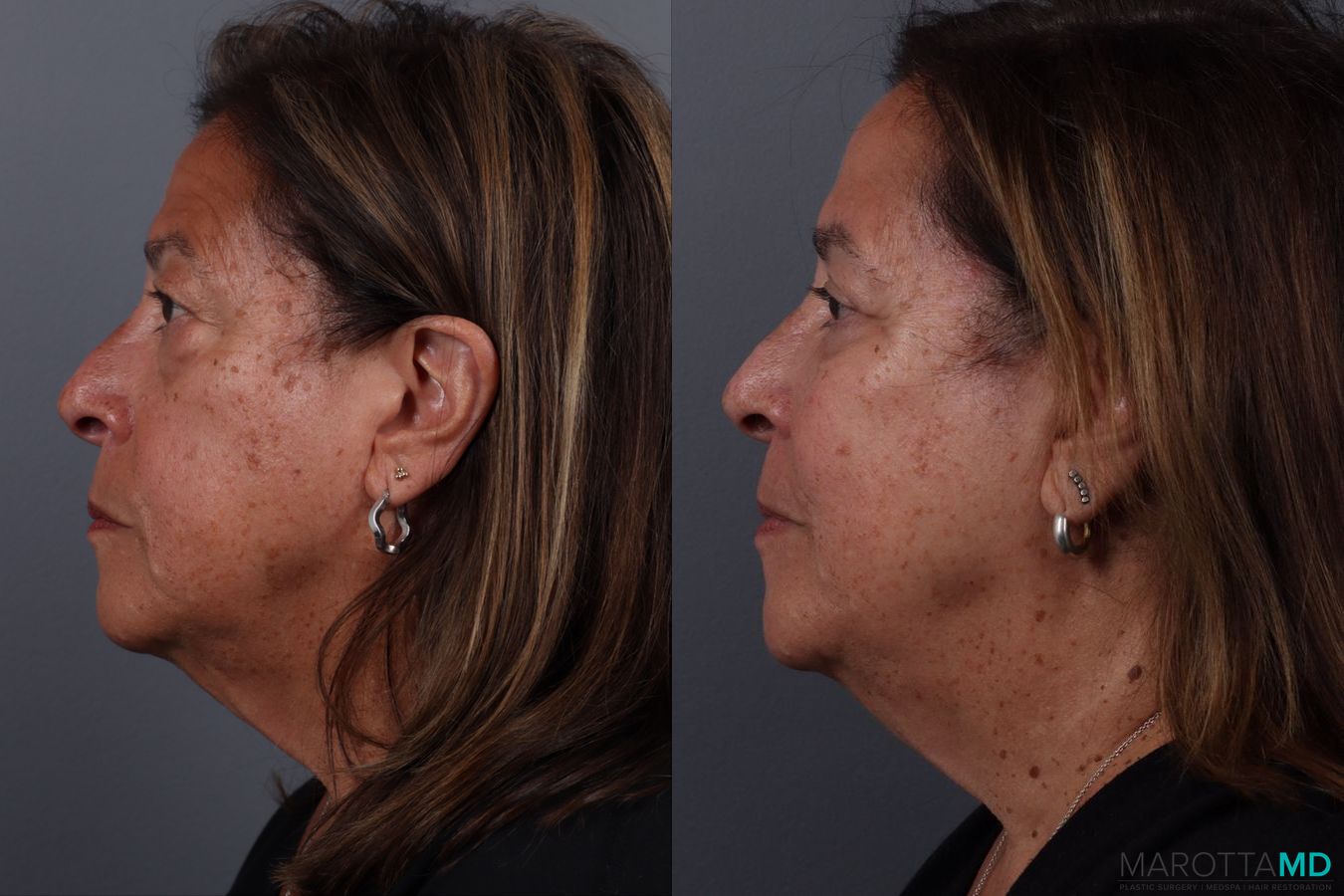 Before and after Blepharoplasty Lower case 19701 - Angle 5