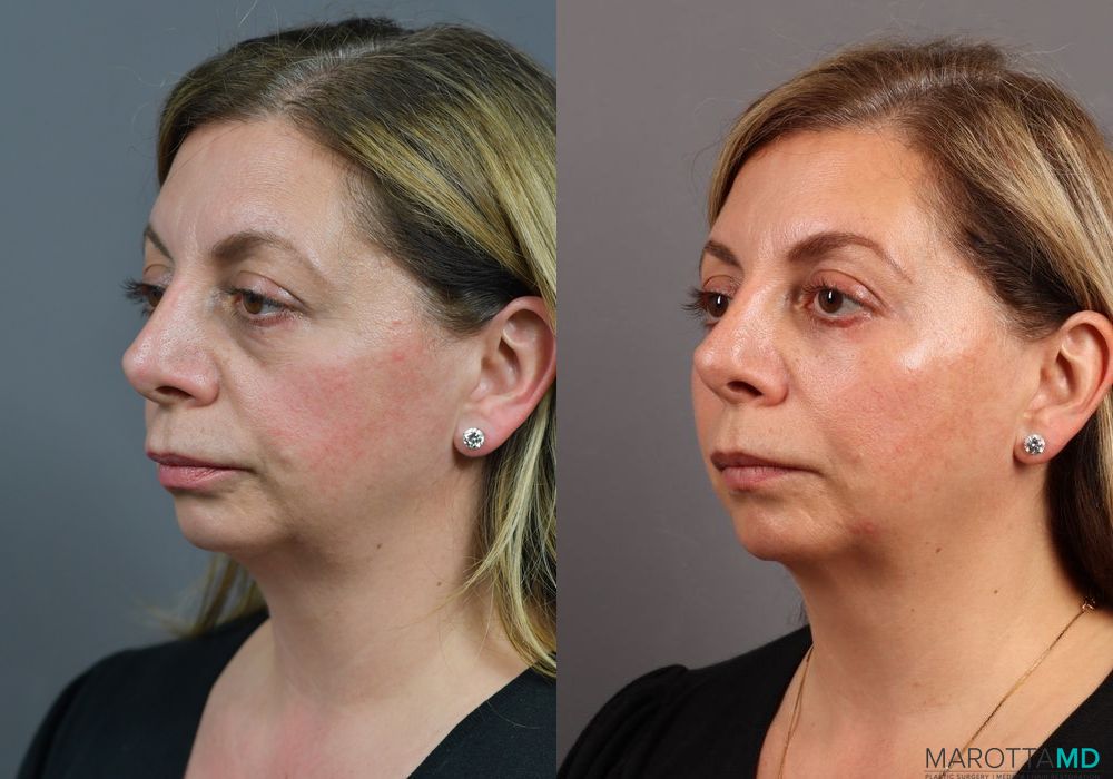 Blepharoplasty Lower - Thumbnail 3