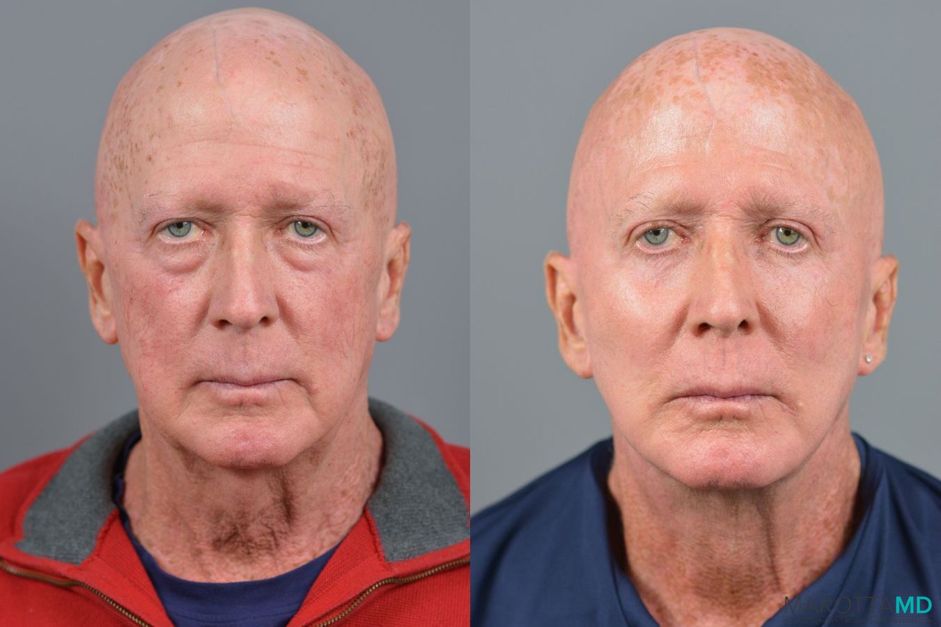 Before and after Blepharoplasty Lower case 7110
