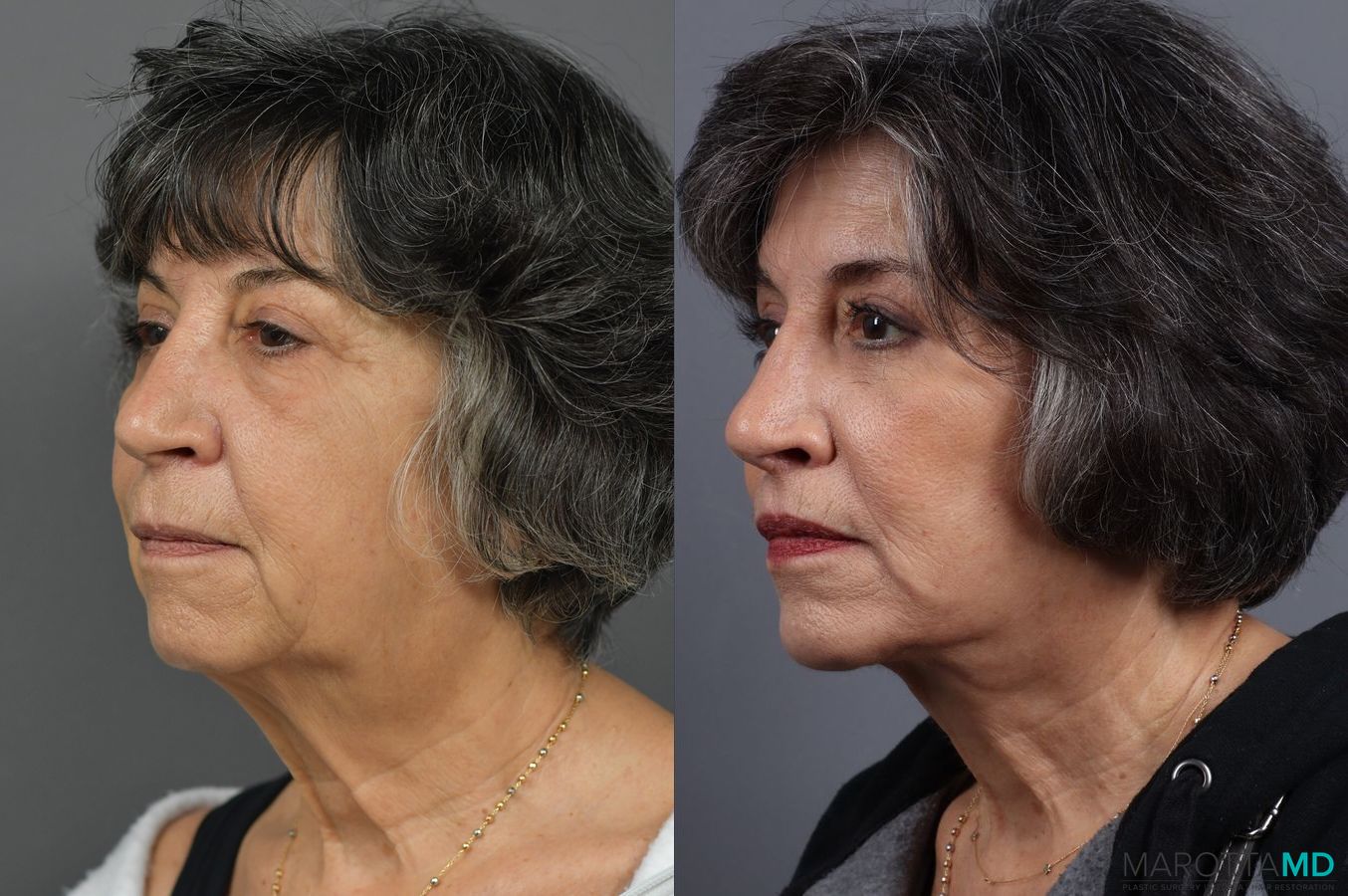Before and after Blepharoplasty Lower case 7126 - Angle 4