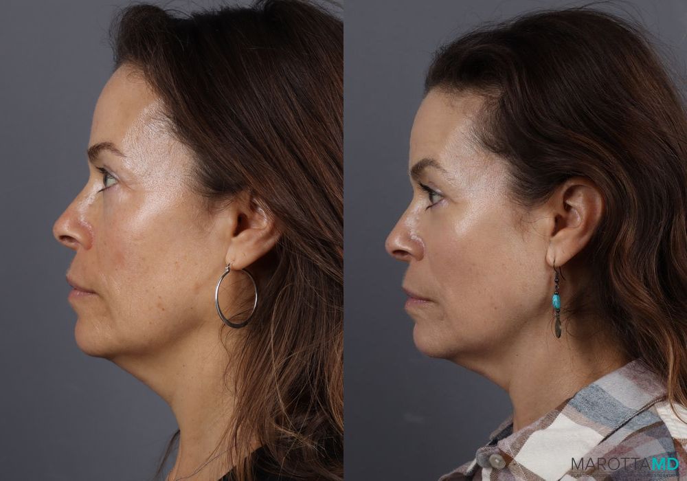Before and after Blepharoplasty Lower case 7099 - Angle 3