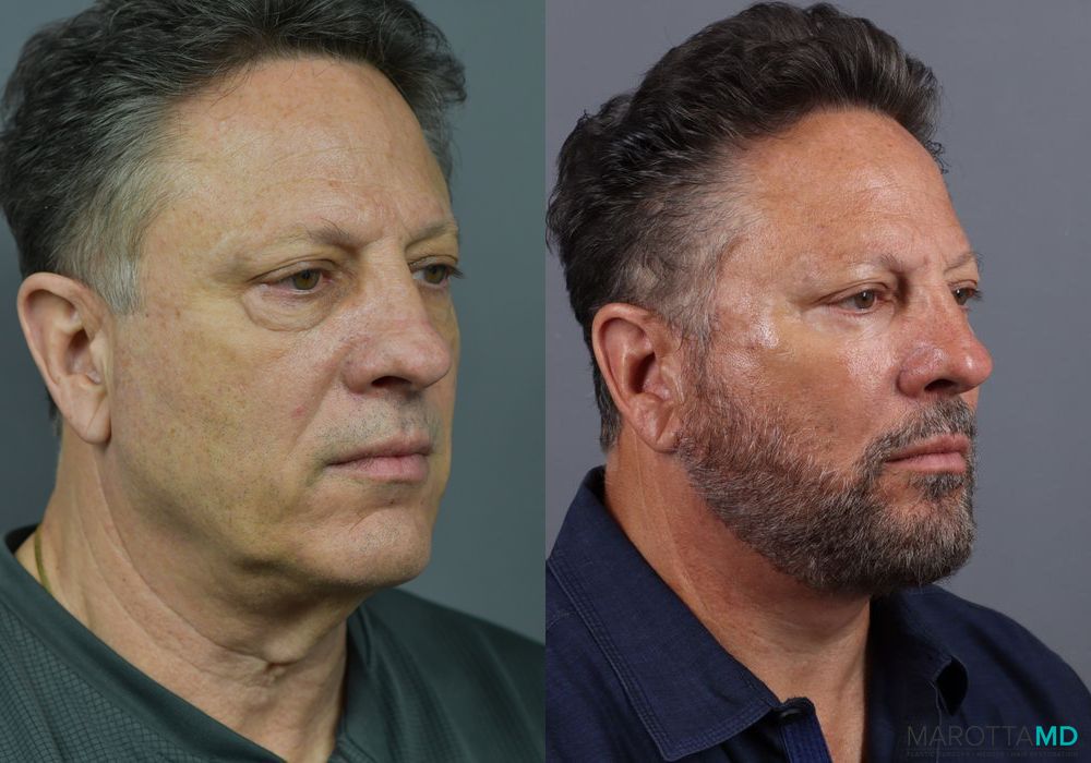 Blepharoplasty Lower - Thumbnail 3