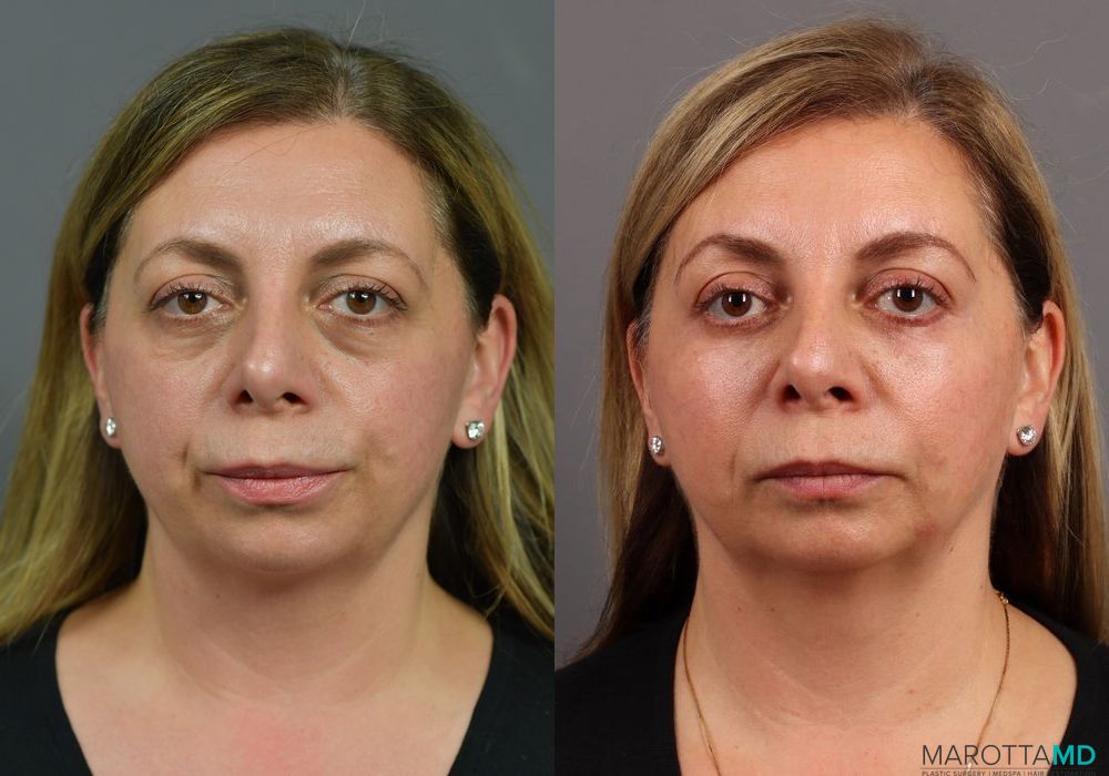 Blepharoplasty Lower - Case 158