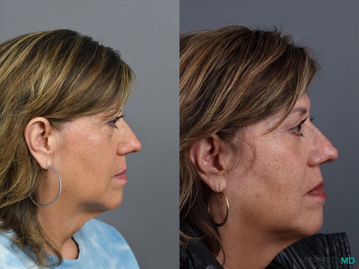 Before and after Blepharoplasty Lower case 21370 - Angle 3