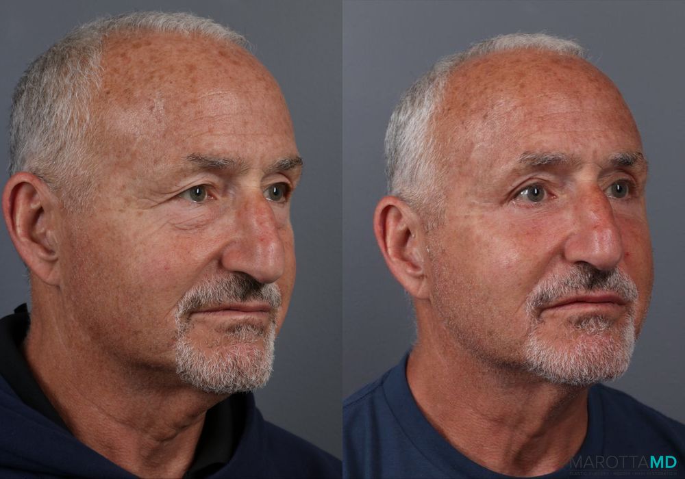 Blepharoplasty Lower - Thumbnail 2