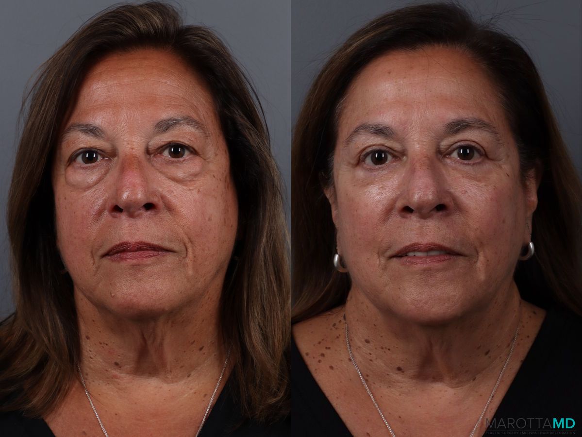 Before and after Blepharoplasty Lower case 19701