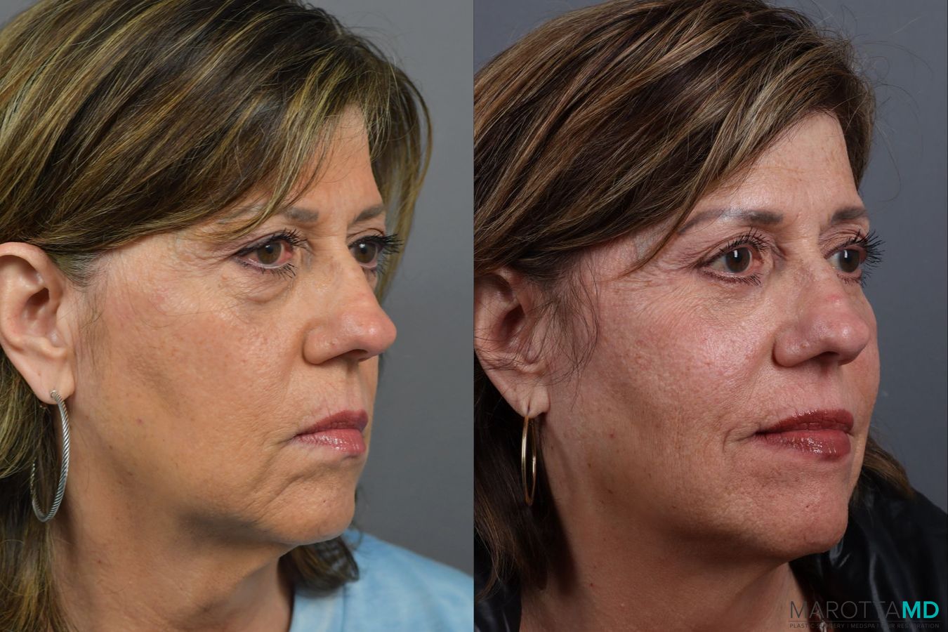 Before and after Blepharoplasty Lower case 21370 - Angle 2