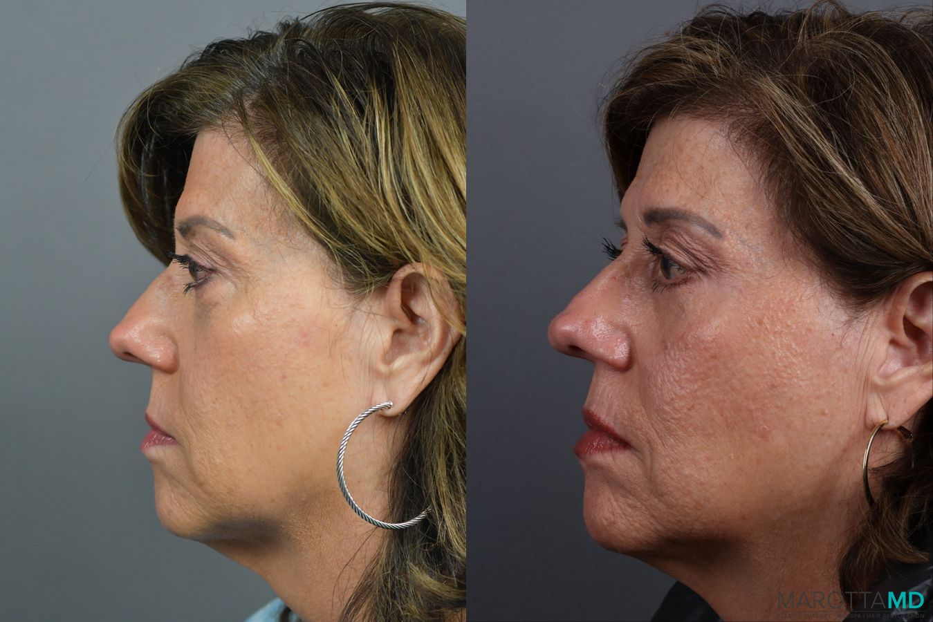 Before and after Blepharoplasty Lower case 21370 - Angle 5