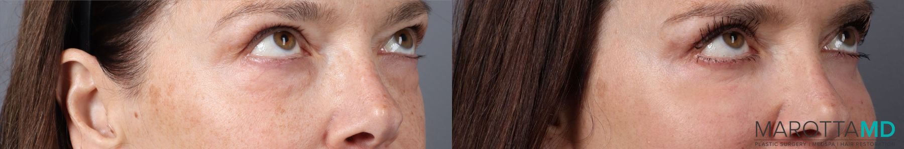 Before and after Blepharoplasty Lower case 43416 - Angle 3