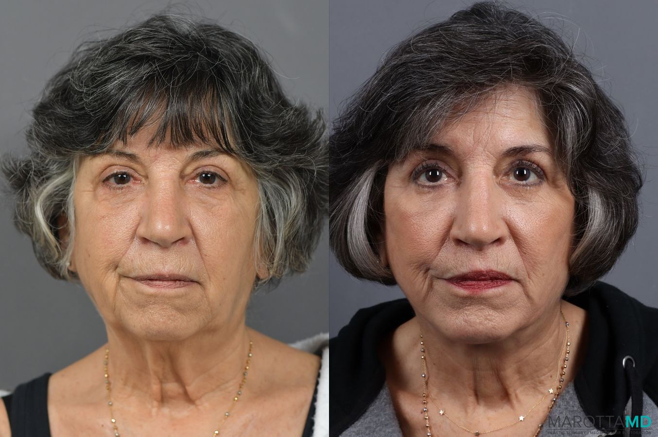 Before and after Blepharoplasty Lower case 7126