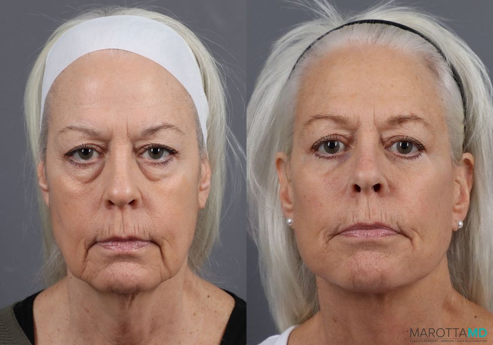 Before and after Blepharoplasty Lower case 7102