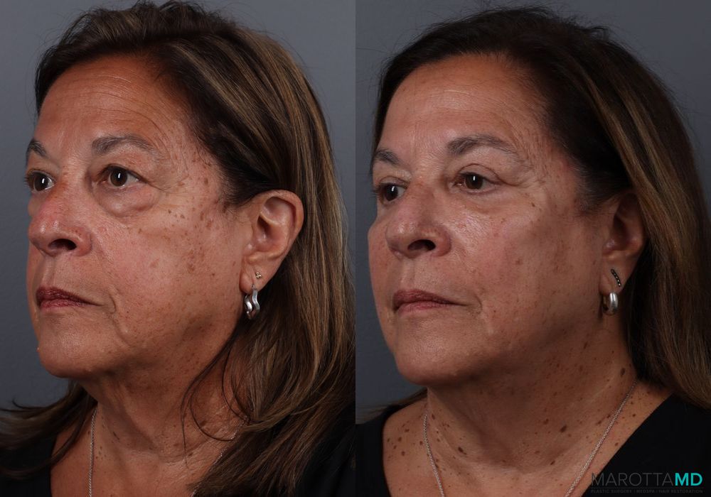 Blepharoplasty Upper - Thumbnail 4