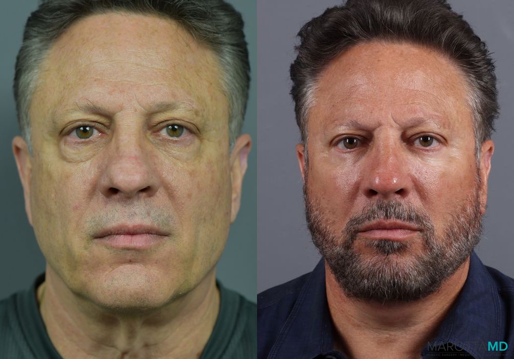 Blepharoplasty Lower - Case 943