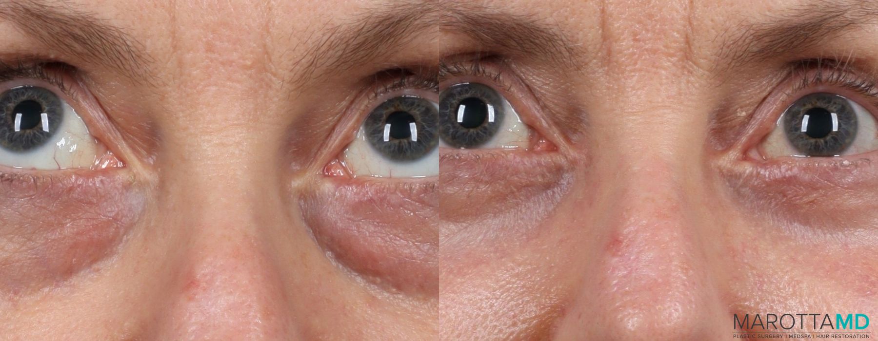 Before and after Blepharoplasty Lower case 7093