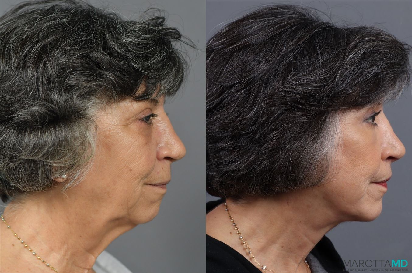 Before and after Blepharoplasty Lower case 7126 - Angle 3