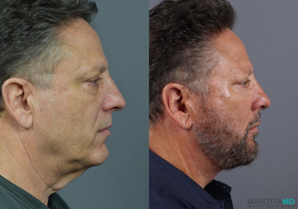 Blepharoplasty Lower - Thumbnail 5