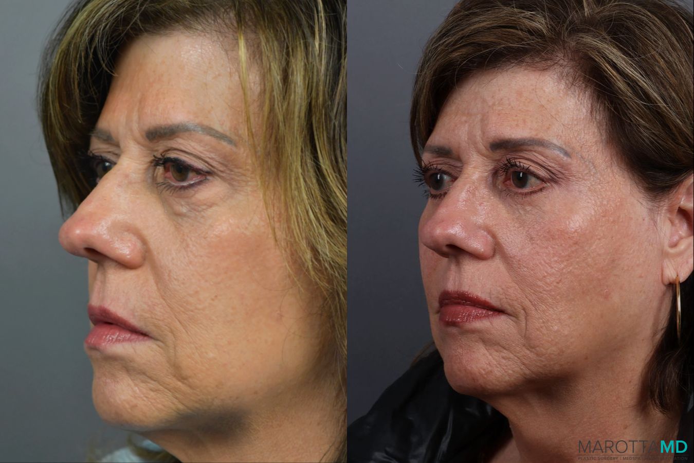 Before and after Blepharoplasty Lower case 21370 - Angle 4