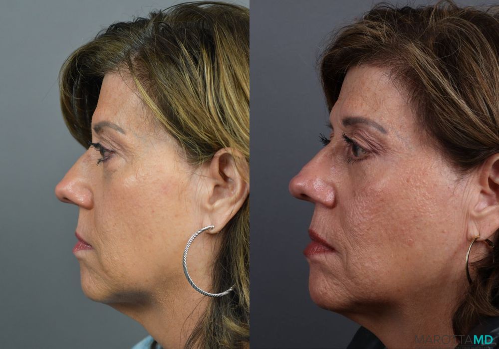 Blepharoplasty Lower - Thumbnail 5