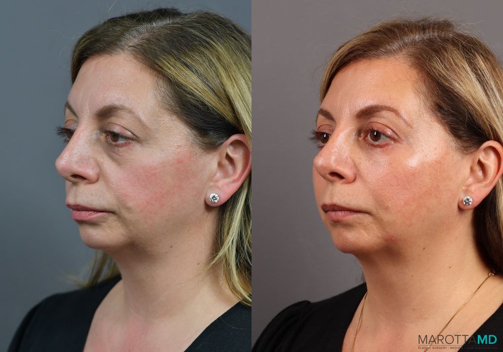 Blepharoplasty Lower - Thumbnail 3