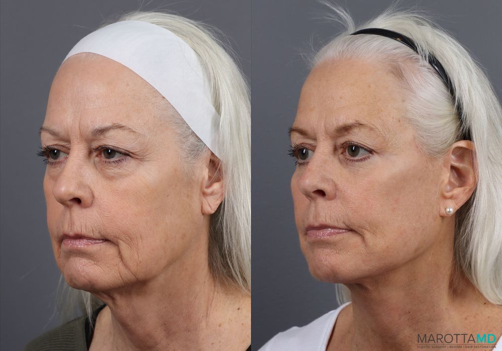 Before and after Blepharoplasty Lower case 7102 - Angle 4