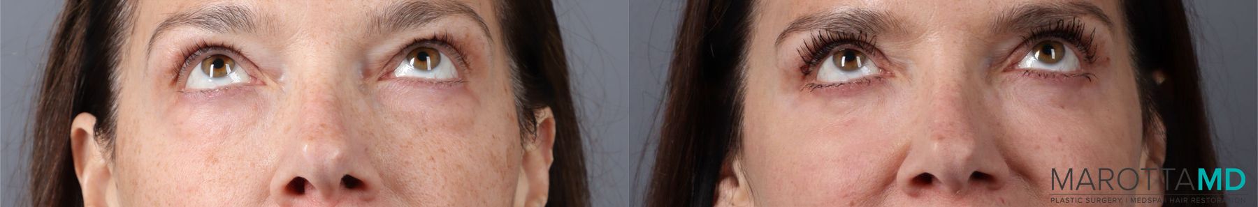 Before and after Blepharoplasty Lower case 43416
