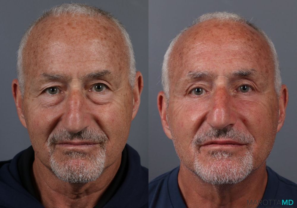 Blepharoplasty Lower - Case 163