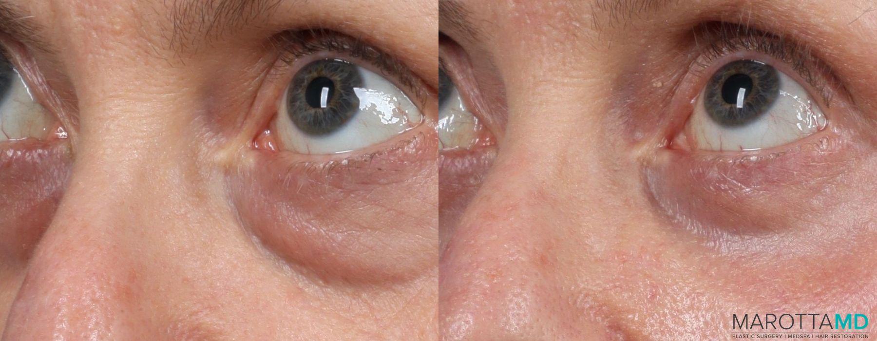 Before and after Blepharoplasty Lower case 7093 - Angle 2