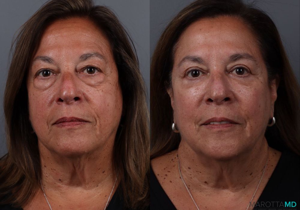 Blepharoplasty Lower - Case 167