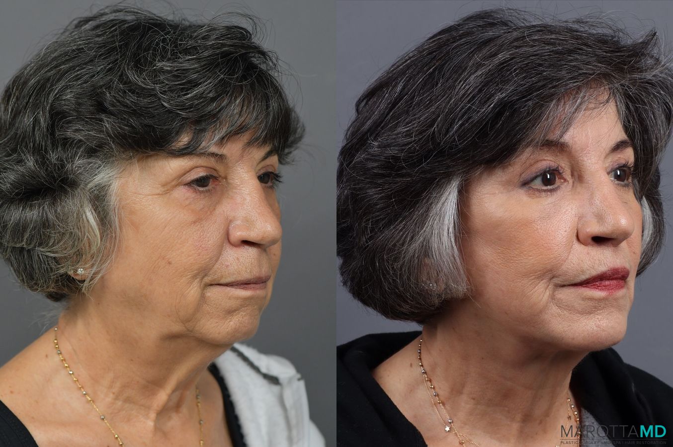 Before and after Blepharoplasty Lower case 7126 - Angle 2