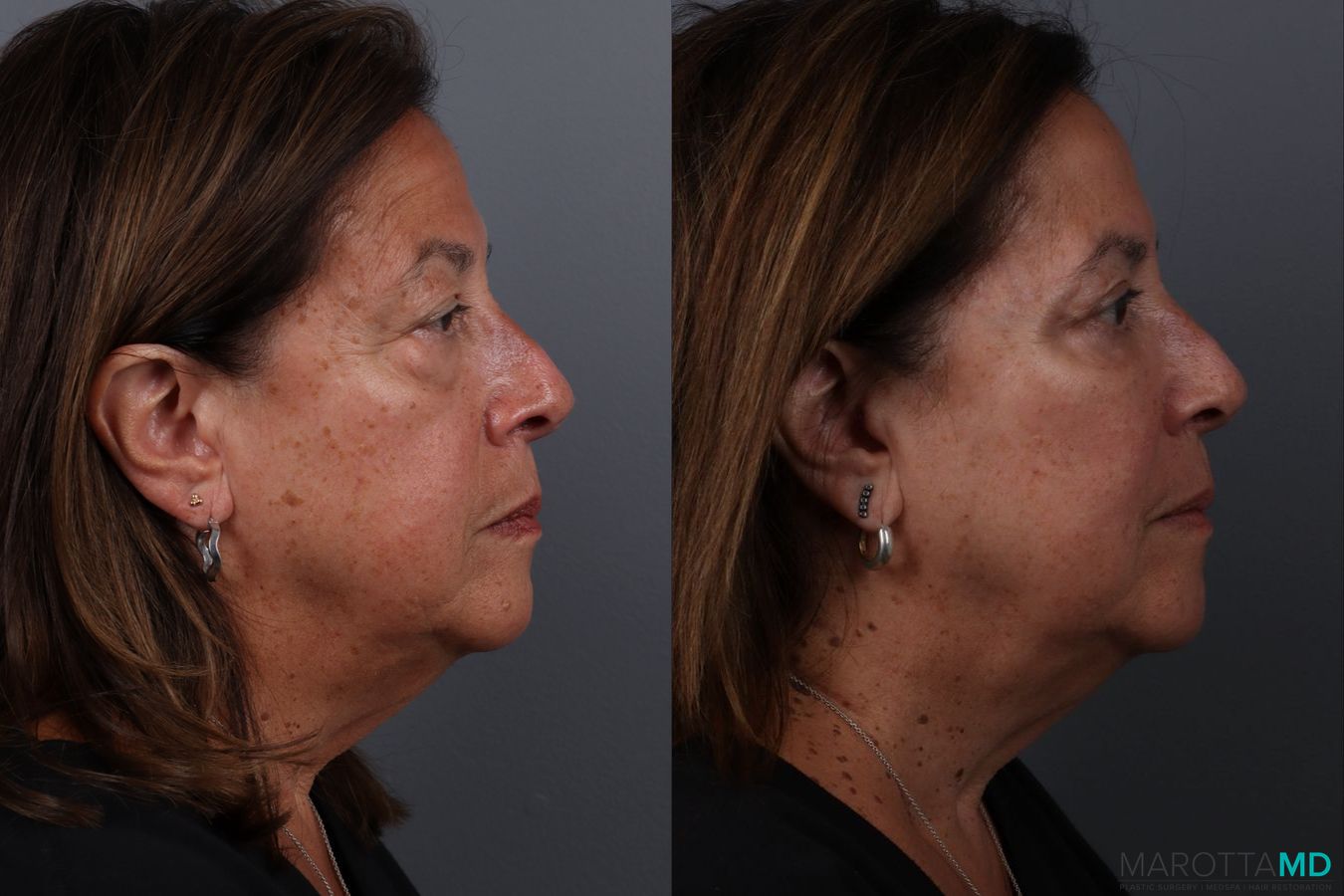 Before and after Blepharoplasty Lower case 19701 - Angle 3