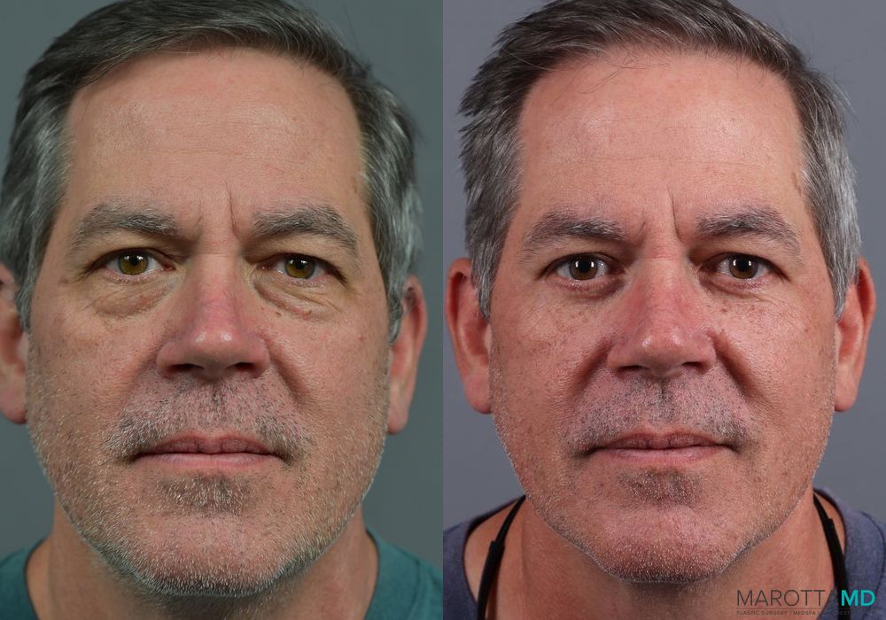 Before and after Blepharoplasty Lower case 7109