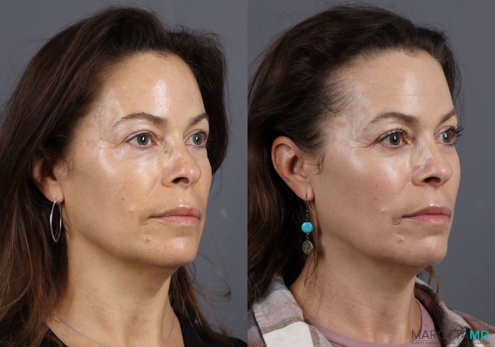 Before and after Blepharoplasty Lower case 7099 - Angle 4