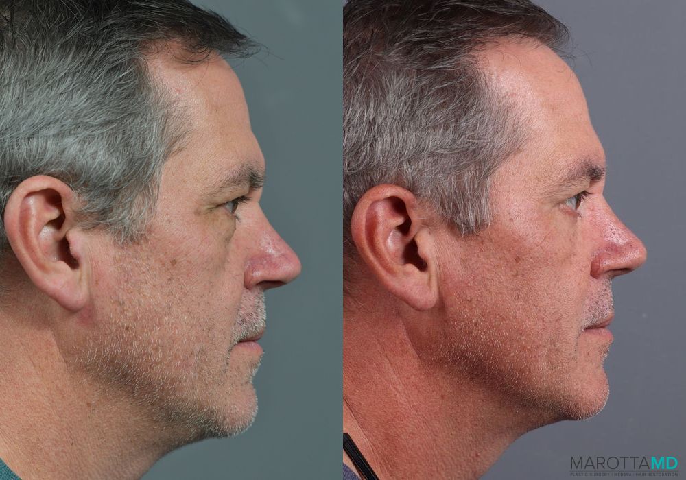 Before and after Blepharoplasty Lower case 7109 - Angle 3