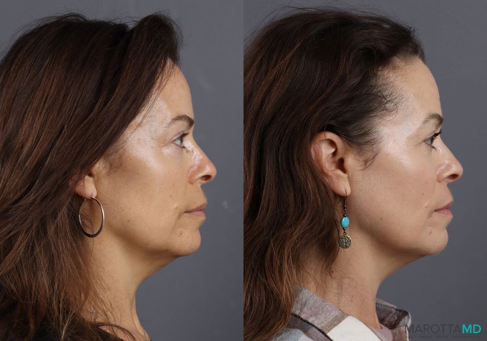 Before and after Blepharoplasty Lower case 7099 - Angle 5