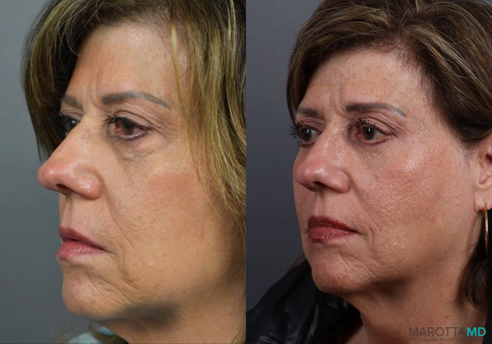 Blepharoplasty Lower - Thumbnail 4