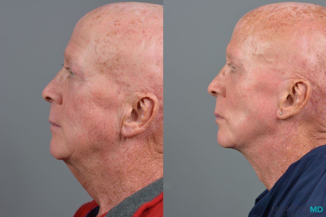 Before and after Blepharoplasty Lower case 7110 - Angle 3