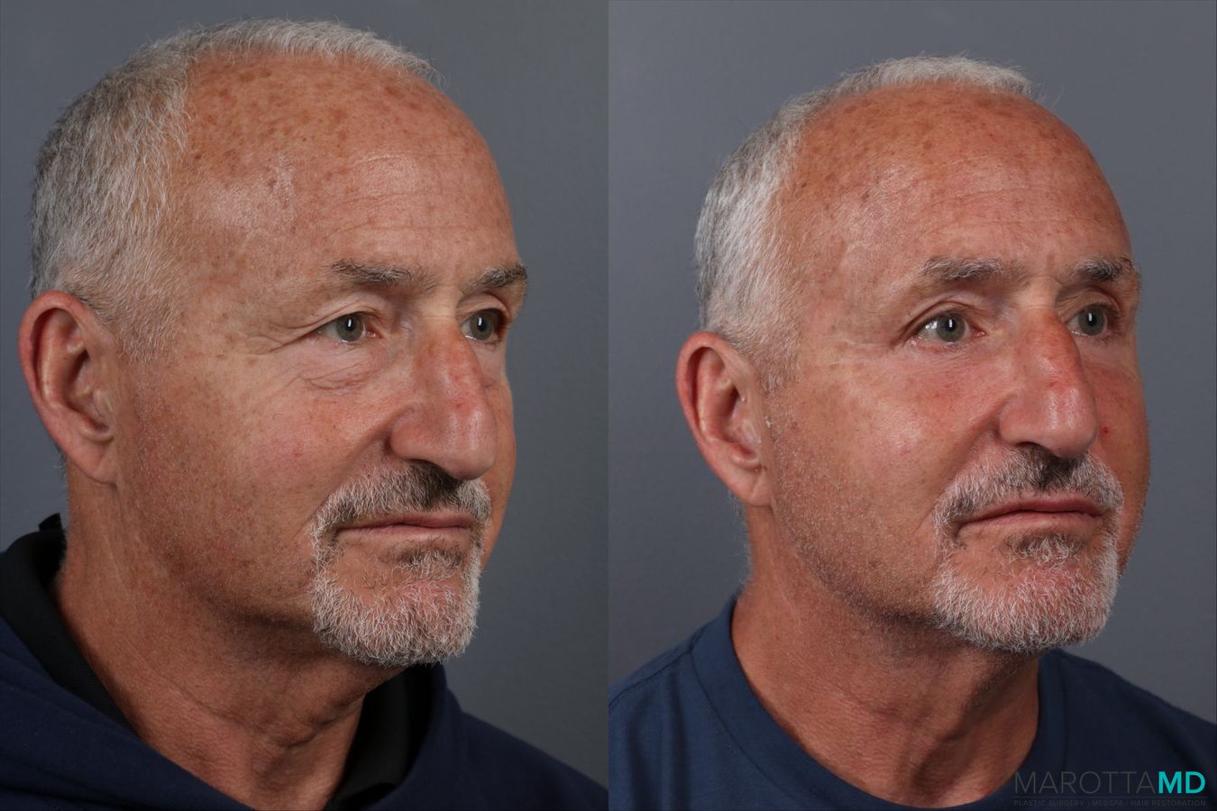 Before and after Blepharoplasty Lower case 17403 - Angle 2