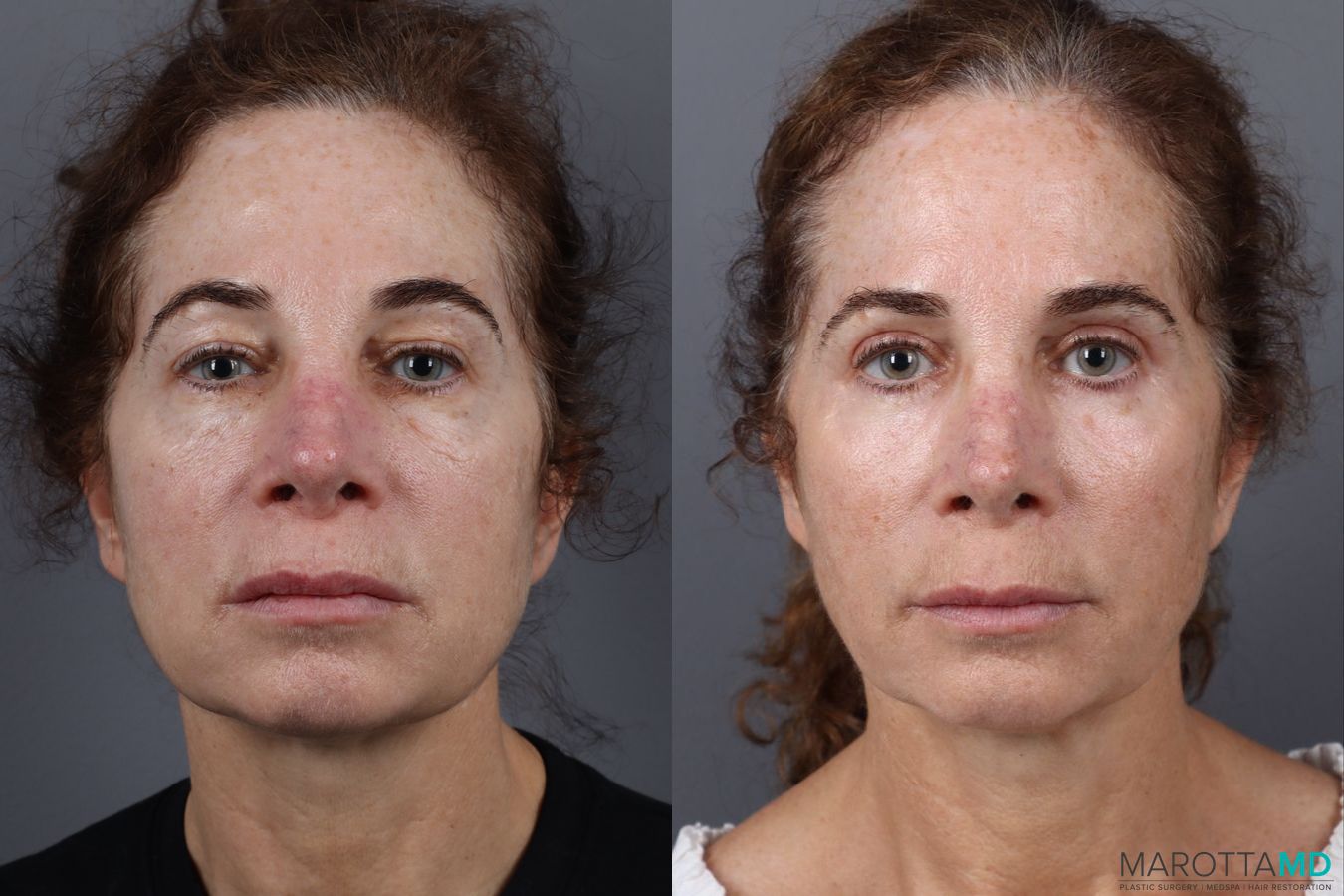 Before and after Blepharoplasty Upper case 18372