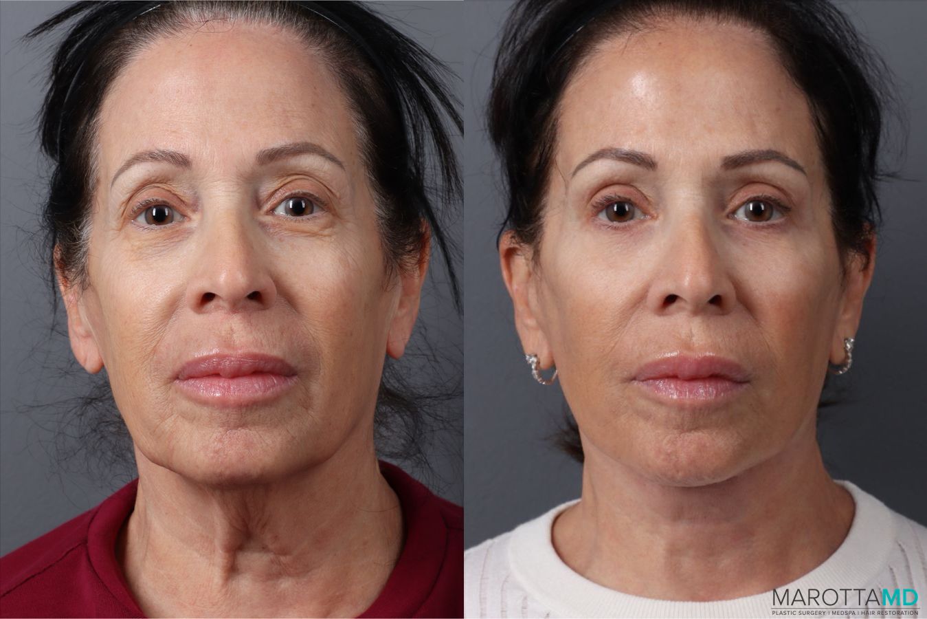 Before and after Blepharoplasty Upper case 49879