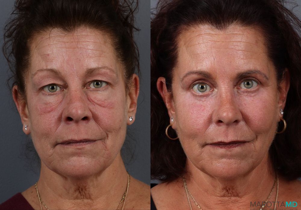 Blepharoplasty Lower - Case 169