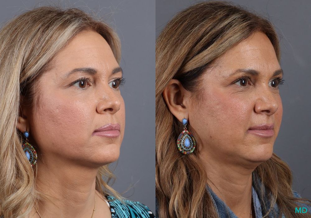 Before and after Blepharoplasty Upper case 7090 - Angle 2