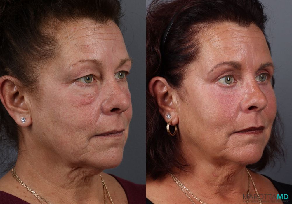 Fat Transfer - Face - Thumbnail 2