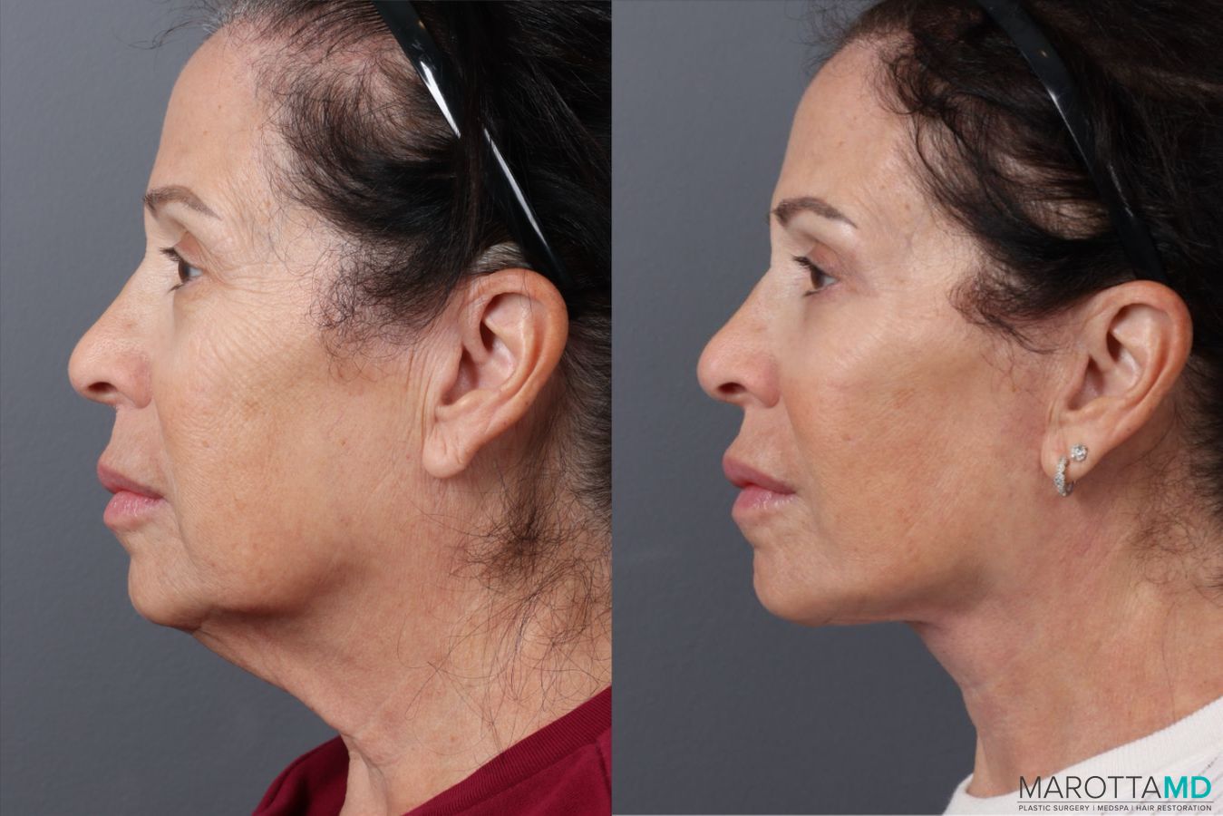 Before and after Facelift & Neck Lift case 49879 - Angle 3