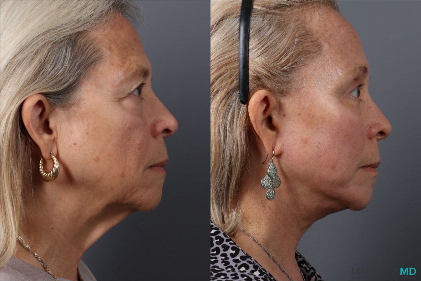 Before and after Blepharoplasty Lower case 43705 - Angle 3