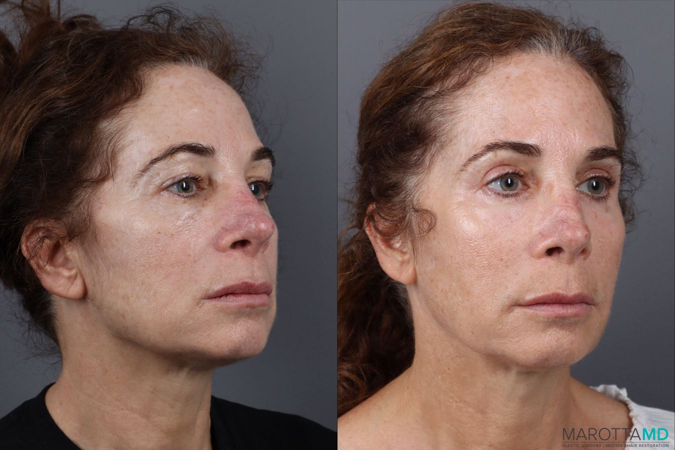 Before and after Blepharoplasty Upper case 18372 - Angle 2