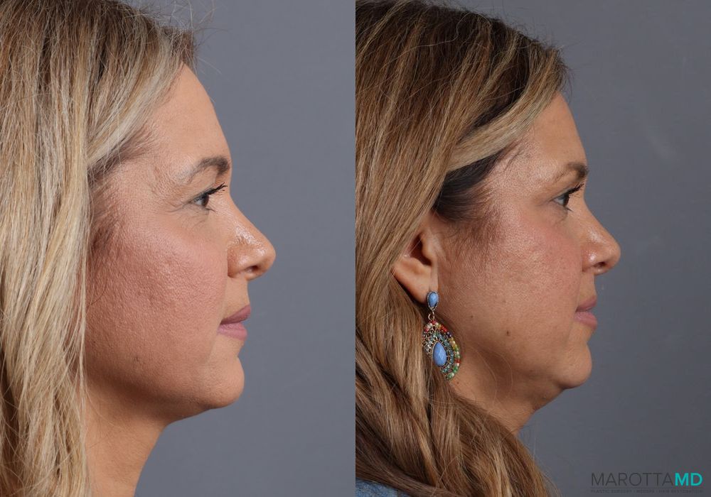 Before and after Blepharoplasty Upper case 7090 - Angle 4