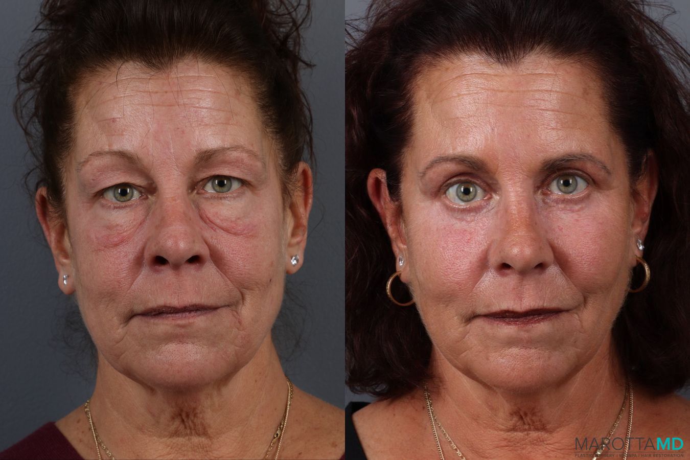 Before and after Fat Transfer - Face case 21514