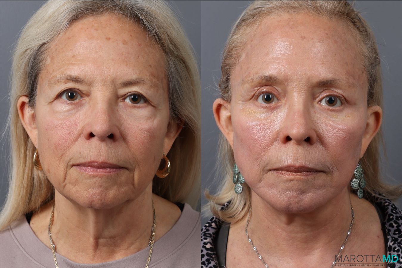 Before and after Blepharoplasty Lower case 43705