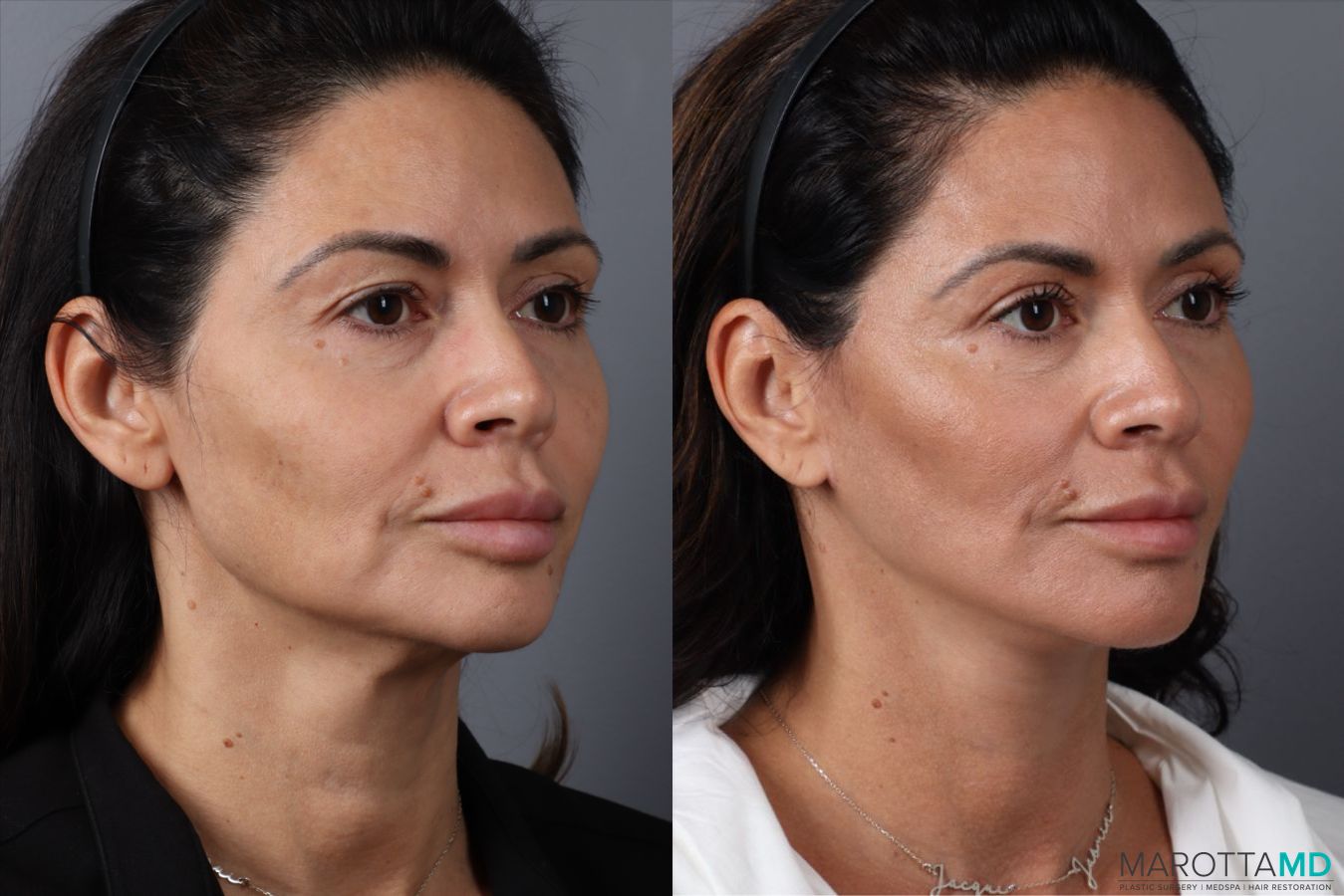 Before and after Mini Facelift case 49463 - Angle 2